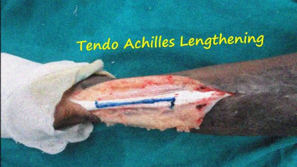 Tendo Achilles Lengthening cover