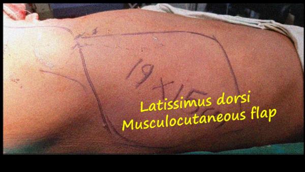 Myocutaneous Latissimus Dorsi Flap cover