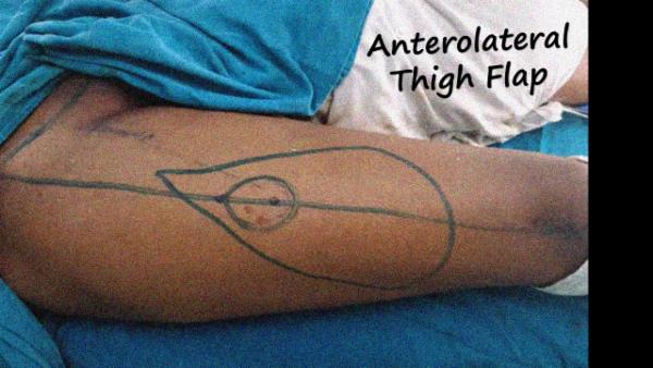 Anterolateral Thigh Flap harvest cover