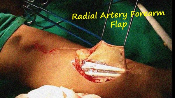 Radial artery forearm flap - Harvest cover