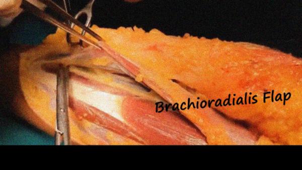 Brachioradialis Flap cover