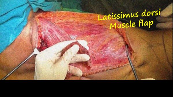Latissimus dorsi muscle flap cover