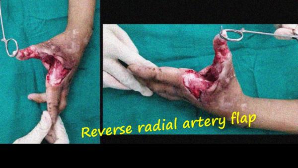 Reverse radial artery flap for hand defect cover