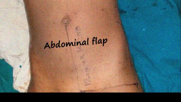 Abdominal flap for hand defect cover