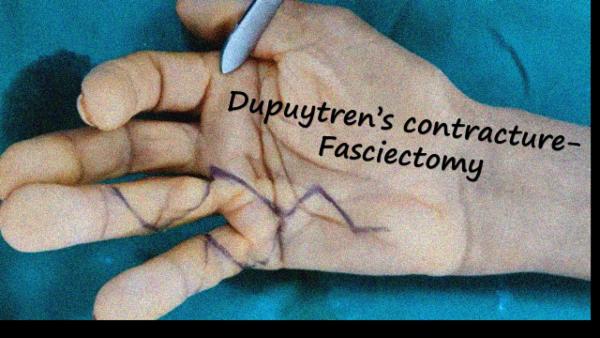 Dupuytren's contracture - Fasciectomy cover