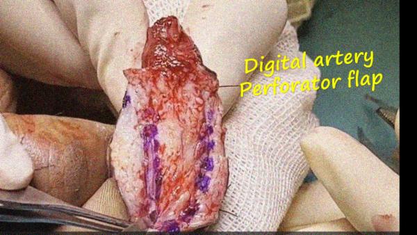 Digital artery perforator flap cover