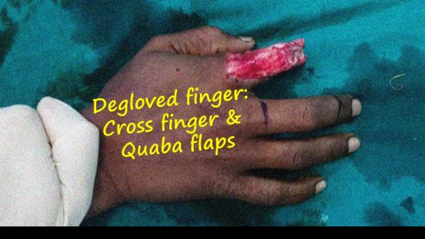 Cross finger & Quaba flap for circumferential finger defect cover