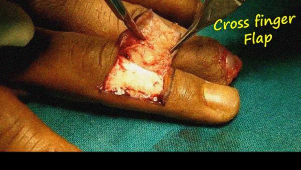 Cross finger flap cover