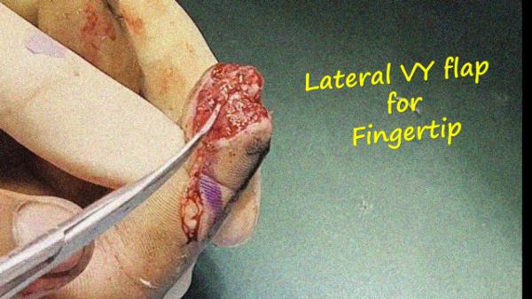 Lateral VY advancement flap for finger tip defect cover
