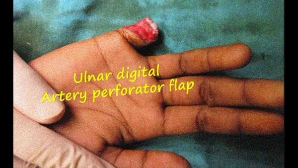 Ulnar digital artery perforator flap for little finger reconstruction cover