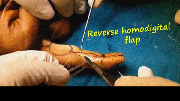 Reverse homodigital flap for fingertip reconstruction cover