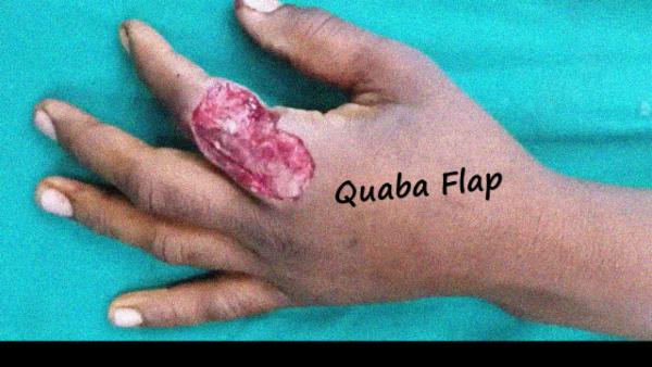 Quaba flap cover
