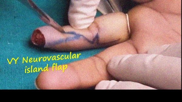 VY neurovascular island flap cover