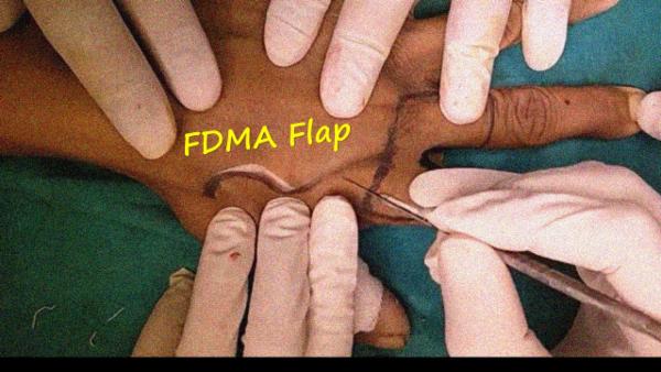 FDMA flap for thumb defect cover