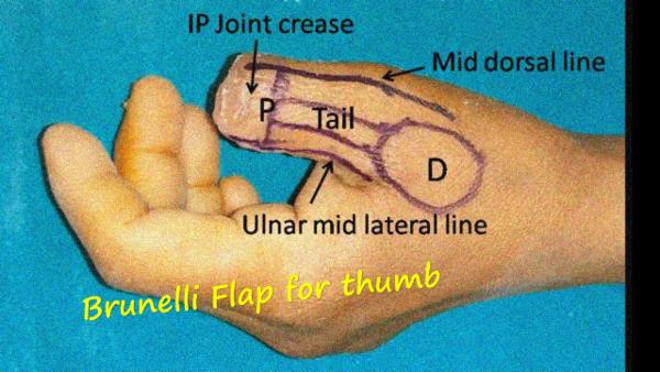 Thumb defect - Brunelli flap/ Dorsocubital flap cover