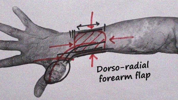 Large thumb defect - Dorsoradial forearm flap cover