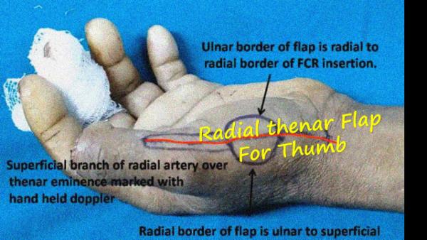 Radial thenar flap for thumb defect cover