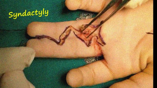 Syndactyly operative video cover