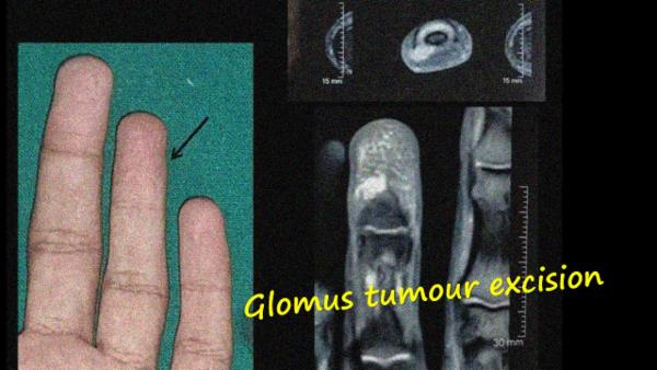 Glomus tumour - Operative video cover