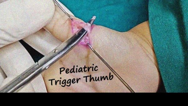 Pediatric trigger thumb cover