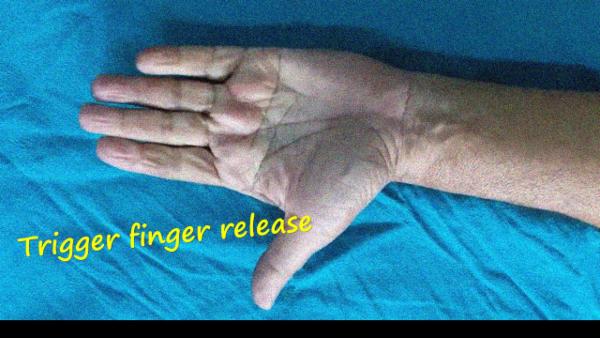 Thread Trigger Finger Release – Trigger Finger Release: Are Sutures ...