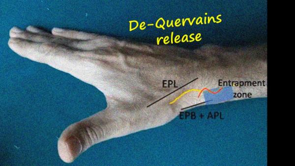 De quervain's tenosynovitis cover