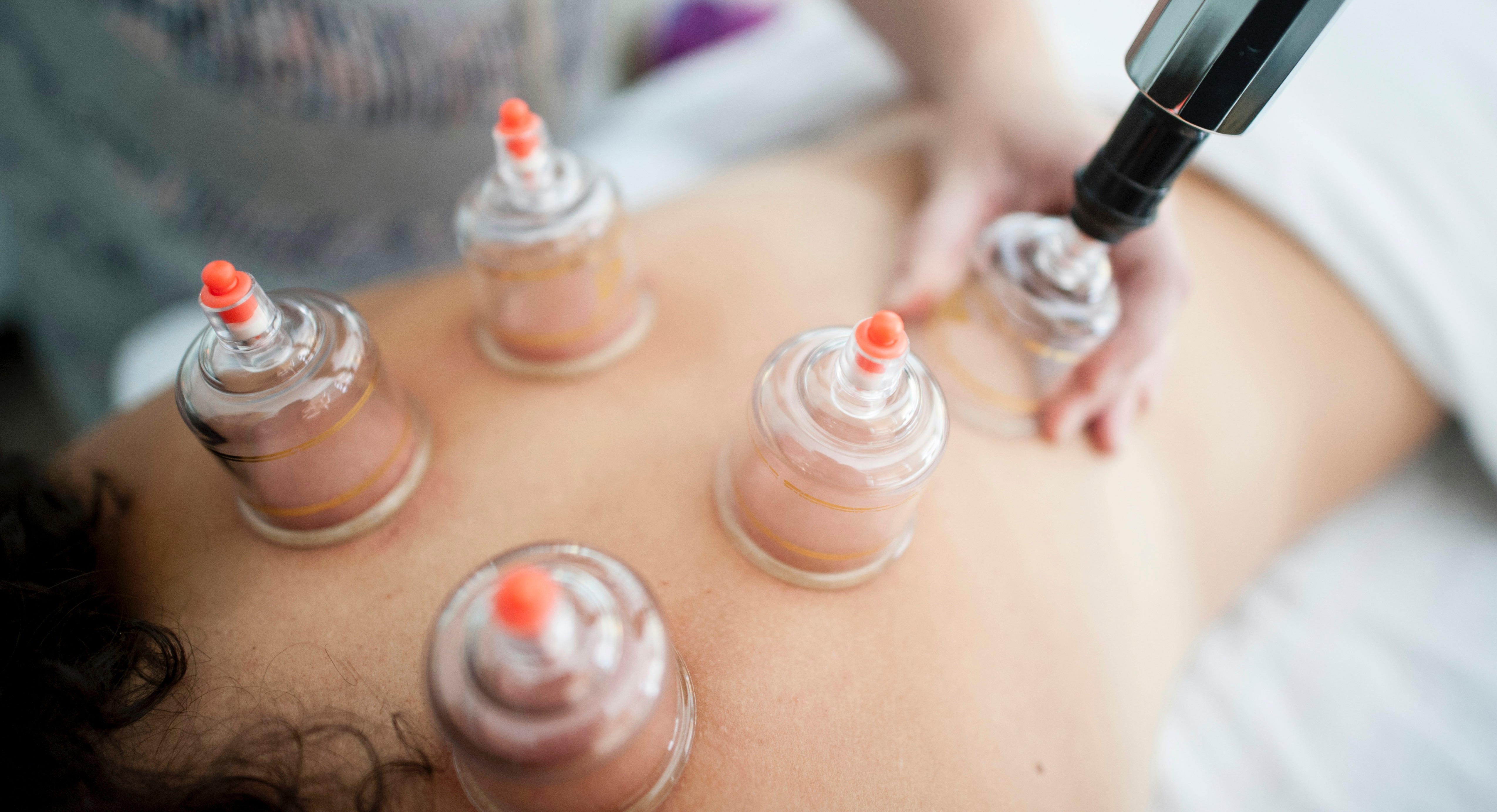  Myofascial Cupping Therapy cover