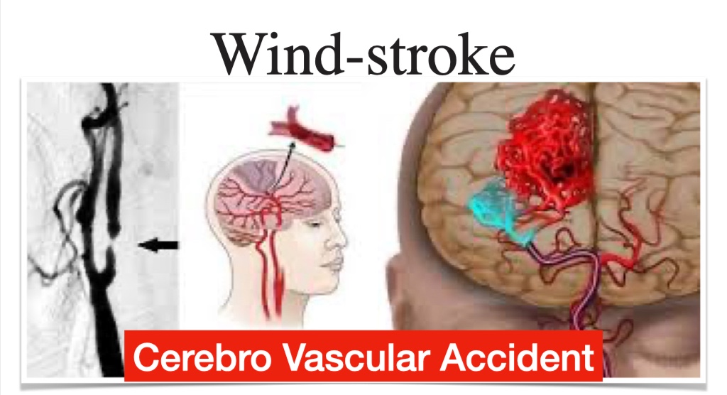  TCM for Wind Stroke , Paralysis , Hemiplegia cover