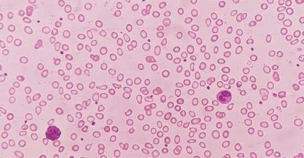 Step wise approach to the diagnosis of anemia cover