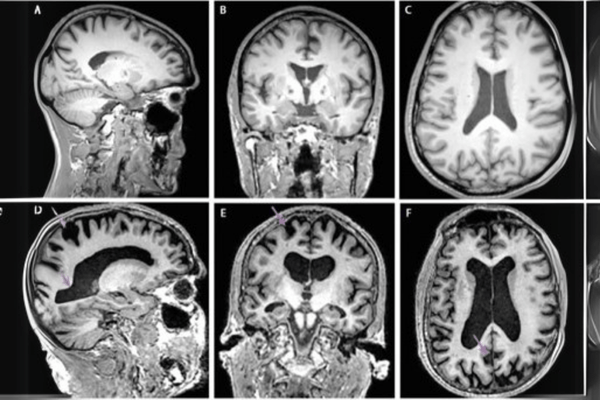 Using CNN for Alzheimer's disease prediction cover