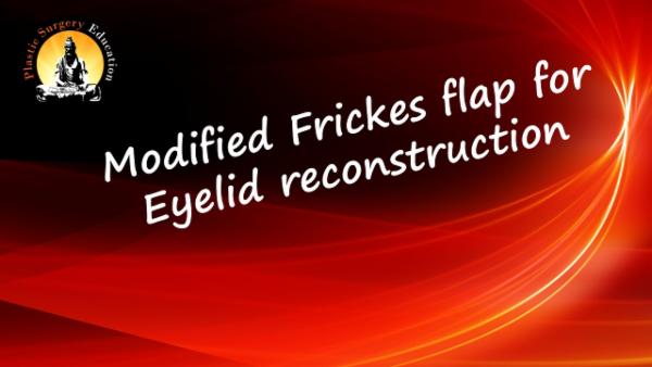 Modified Frickes Flap for Eyelid Reconstruction cover