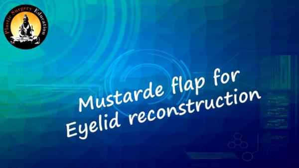 Mustarde Flap for Eyelid Reconstruction cover
