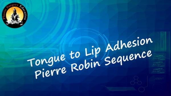 Tongue to Lip adhesion - Pierre Robin Sequence cover