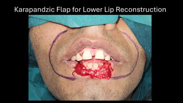 Karapandzic flap for lower lip reconstruction cover