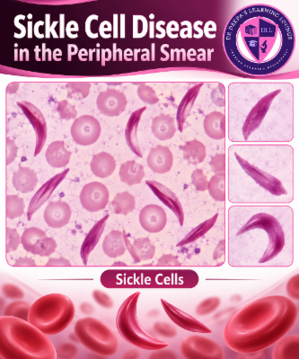Sickle Cell Disease in the Peripheral Smear: What the Pathologist Should Look For cover